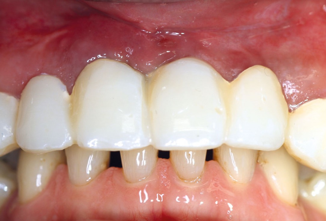 botiss maxgraft® bonebuilder aesthetic reconstruction - Clinical case
