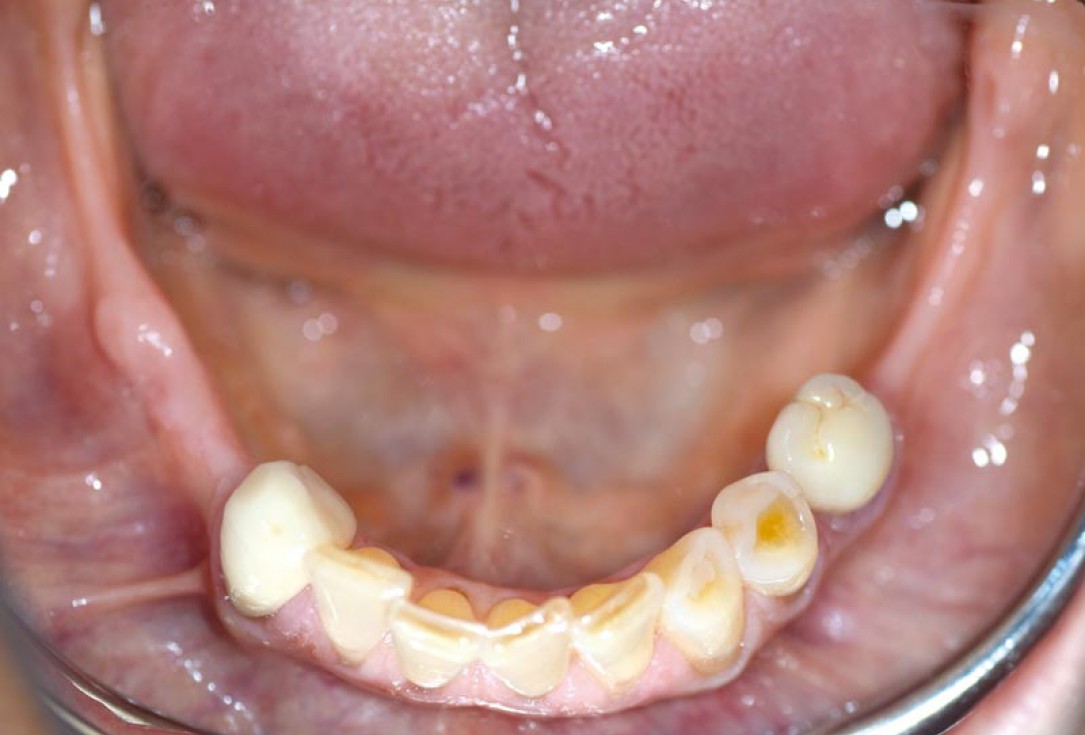Block augmentation with maxgraft® in the mandible - PD Dr. Dr. F. Kloss