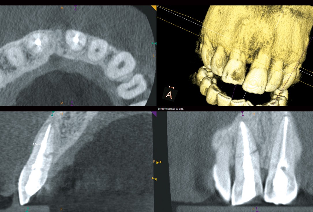 Block augmentation with maxgraft® and cerabone® – Dr. F. Kloss