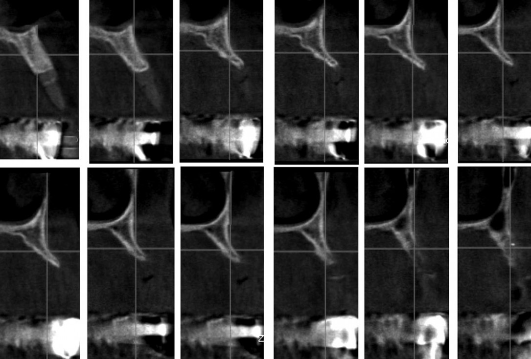 Reconstruction of Anterior Maxilla with maxgraft® bonebuilder – Dr. B. Han