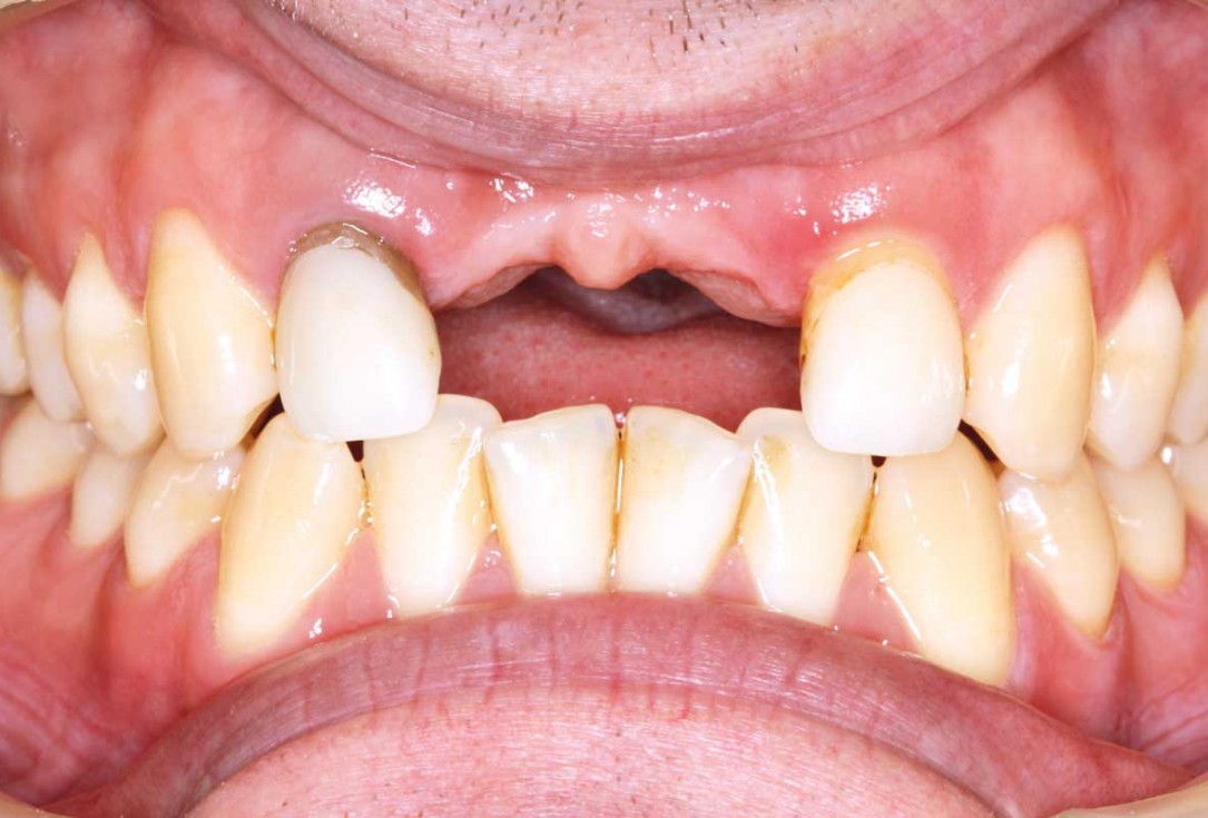 Ridge augmentation in the maxilla with maxgraft® bonebuilder in the aesthetic zone - Dr. M. Kristensen