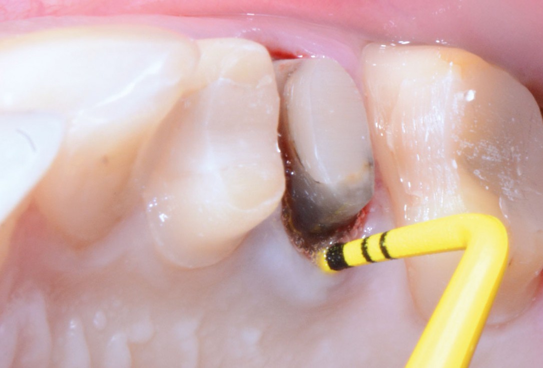 Full bone regeneration in extraction socket augmented with maxgraft® and Jason® membrane – Dr. C. Landsberg