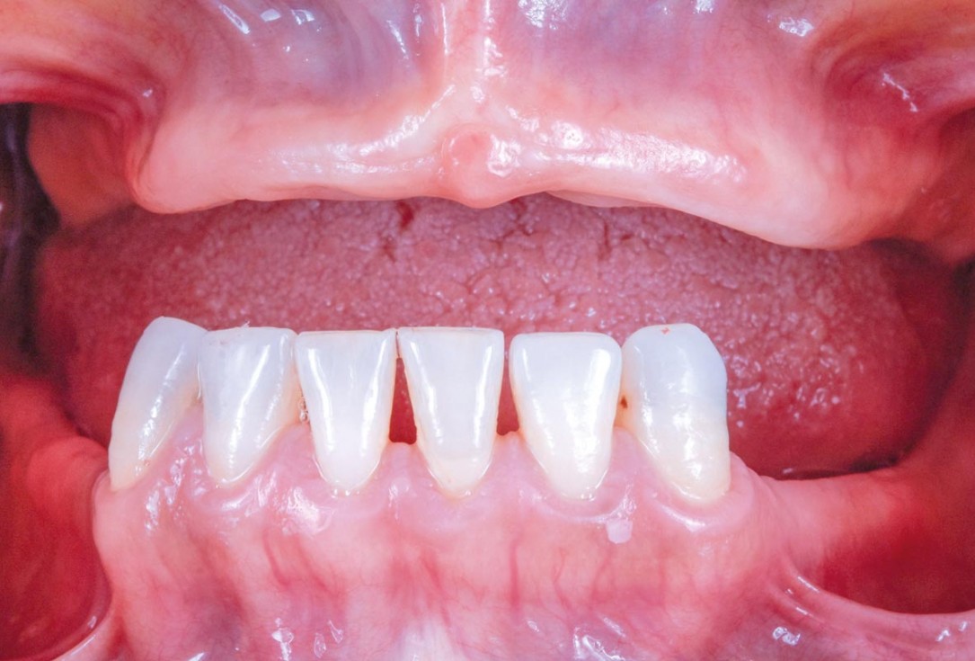 Full arch GBR using botiss cerabone®, maxgraft® and Jason® membrane with simultaneous implantation of 6 Straumann® implants - Dres. A. Signorio and G. Molina