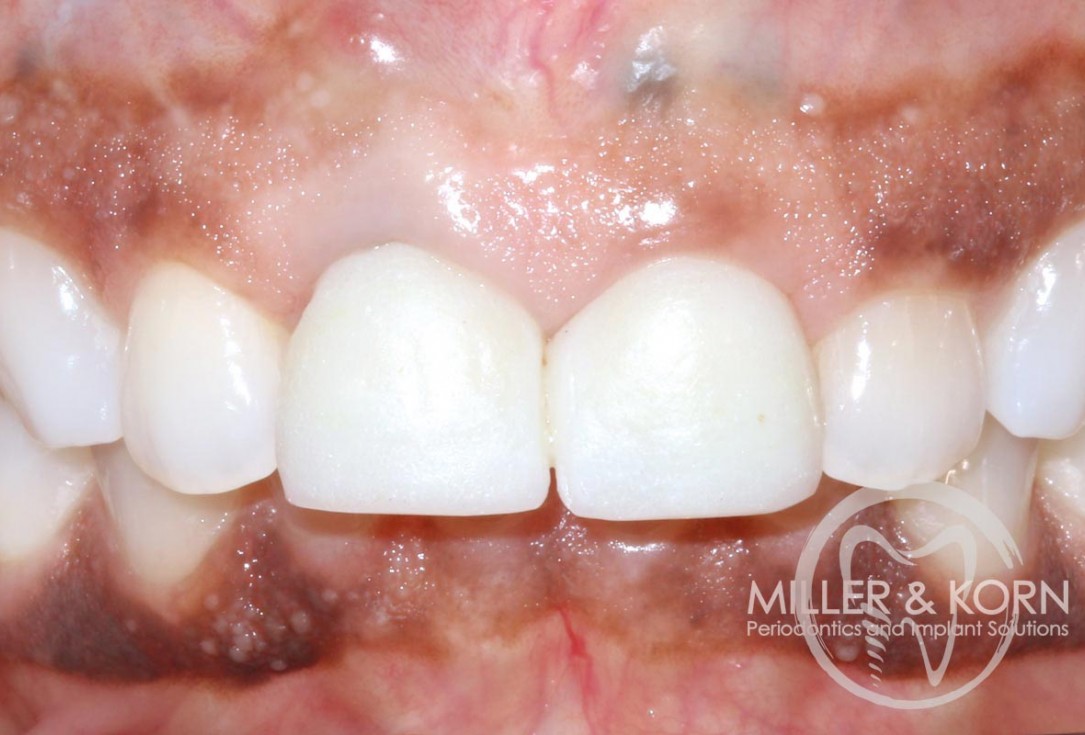 Immediate implant placement and regeneration of ridge using an allograft bone ring and Jason® membrane - Drs. Miller and Korn