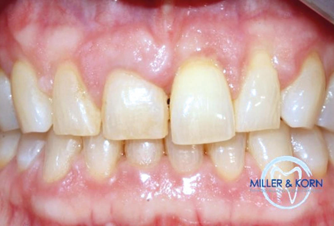 Immediate implant placement and correction of horizontal and vertical bone loss using an allograft bone ring, cerabone® and Jason® membrane - Drs. Miller and Korn