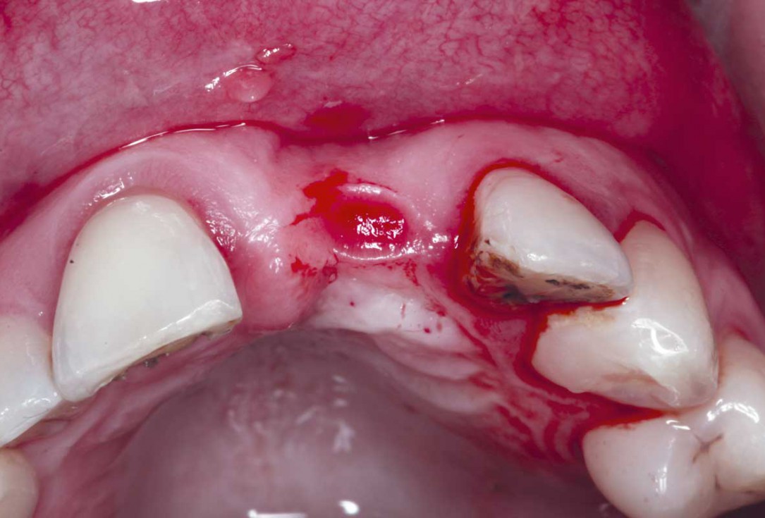 Block grafting in the aesthetic zone with maxgraft®, Jason® membrane and cerabone® - Dres. H. Maghaireh and V. Ivancheva