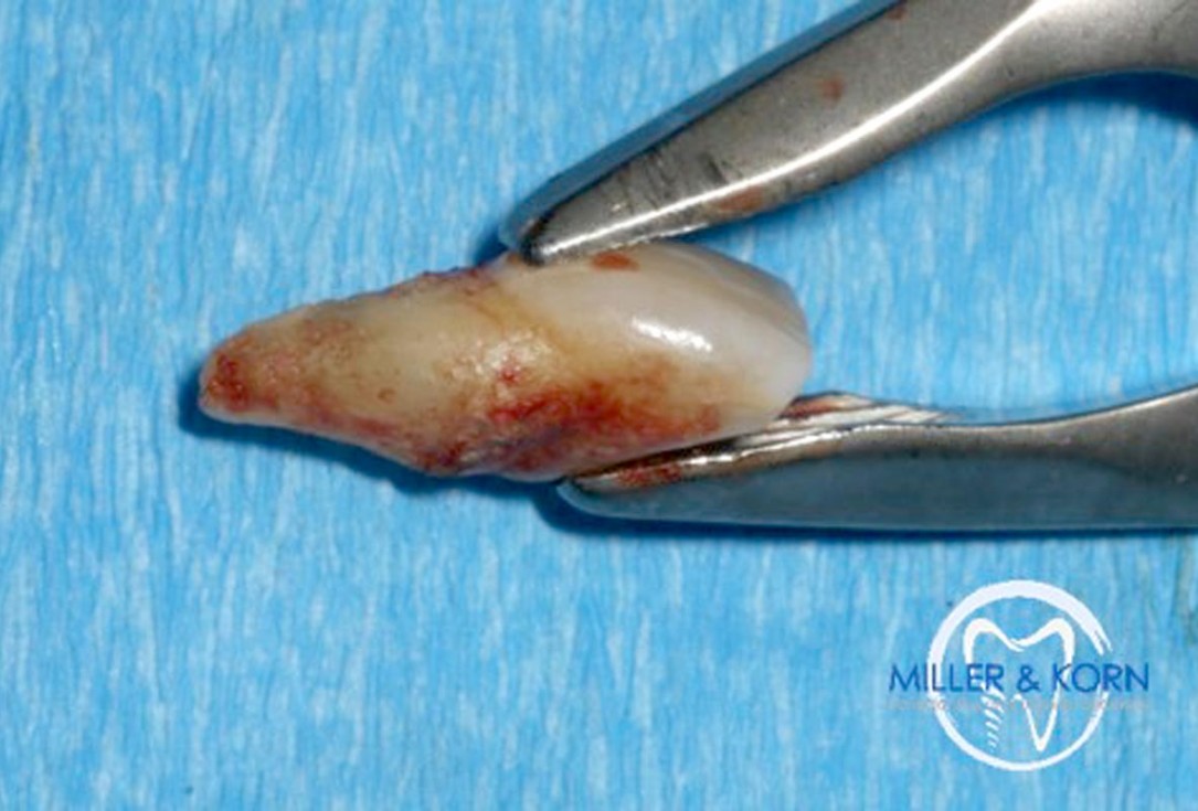 Immediate implant placement and correction of horizontal and vertical bone loss using an allograft bone ring, cerabone® and Jason® membrane - Drs. Miller and Korn