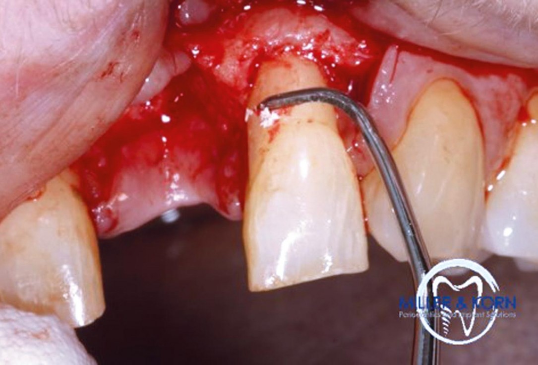 Immediate implant placement and correction of horizontal and vertical bone loss using an allograft bone ring, cerabone® and Jason® membrane - Drs. Miller and Korn