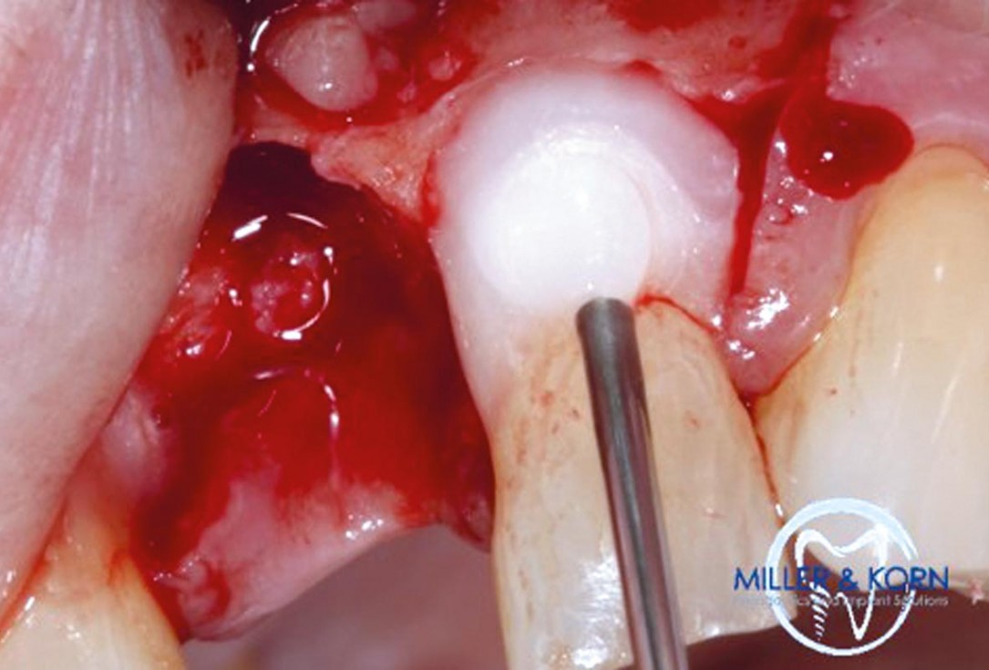 Immediate implant placement and correction of horizontal and vertical bone loss using an allograft bone ring, cerabone® and Jason® membrane - Drs. Miller and Korn