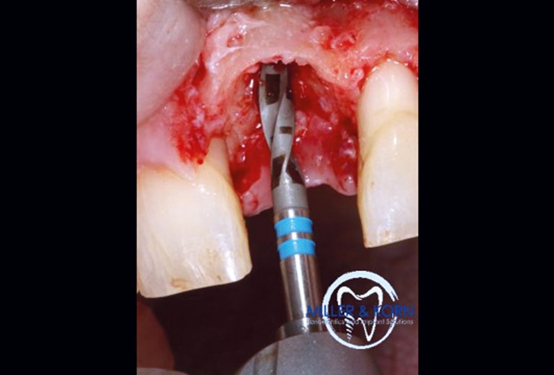 Immediate implant placement and correction of horizontal and vertical bone loss using an allograft bone ring, cerabone® and Jason® membrane - Drs. Miller and Korn