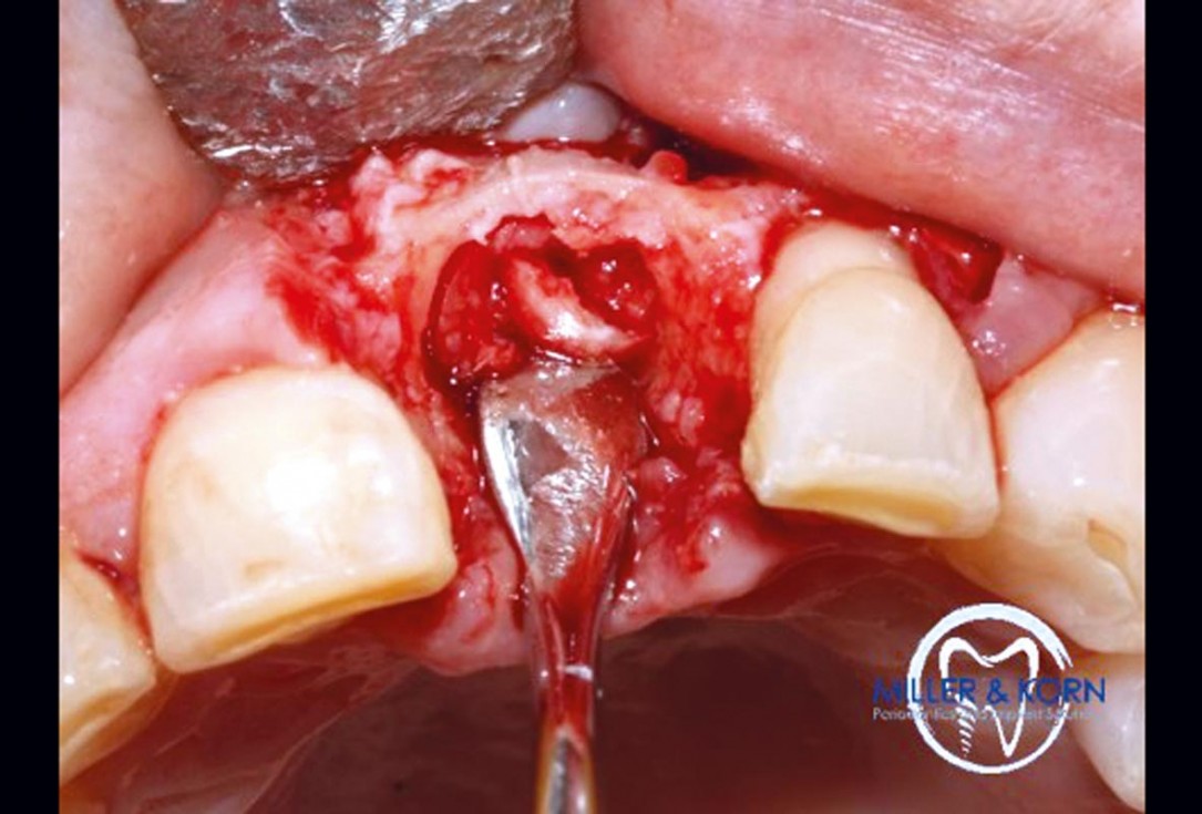 Immediate implant placement and correction of horizontal and vertical bone loss using an allograft bone ring, cerabone® and Jason® membrane - Drs. Miller and Korn