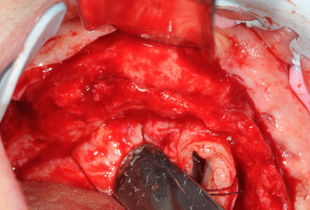 Reconstruction of maxillary ridge with maxgraft® block - Amit Patel