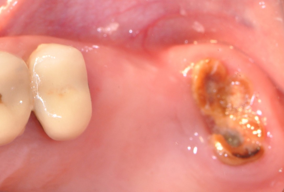 Sinus lift with simultaneous implantation with cerabone® and collprotect® membrane - clinical case Dr. Victor Kalenchuk