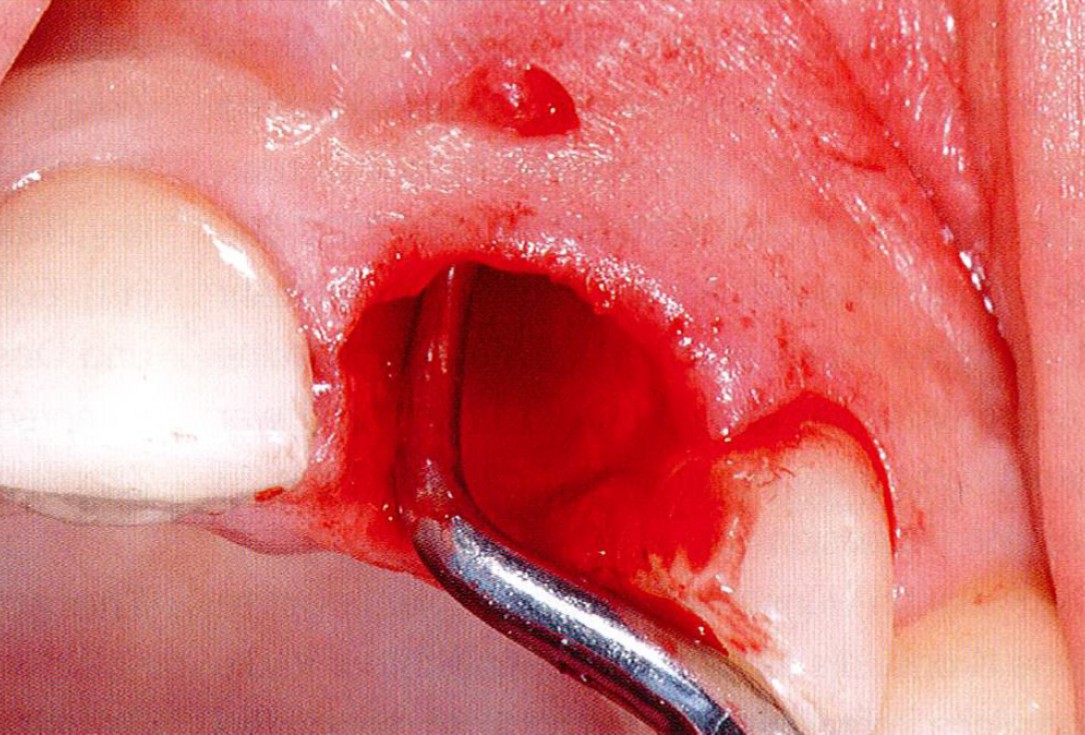 GBR together with soft tissue augmentation with mucoderm® and maxresorb® - Scherg