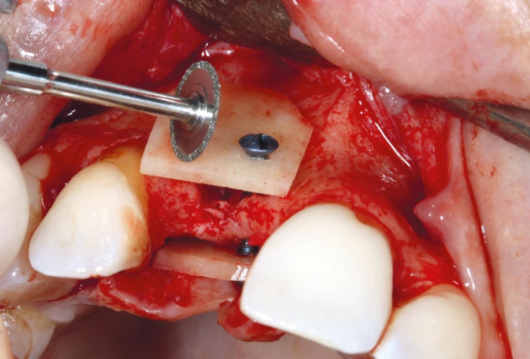 3/11 maxgraft® cortico at combined defect palatally and facially - Dr. K. Höckl