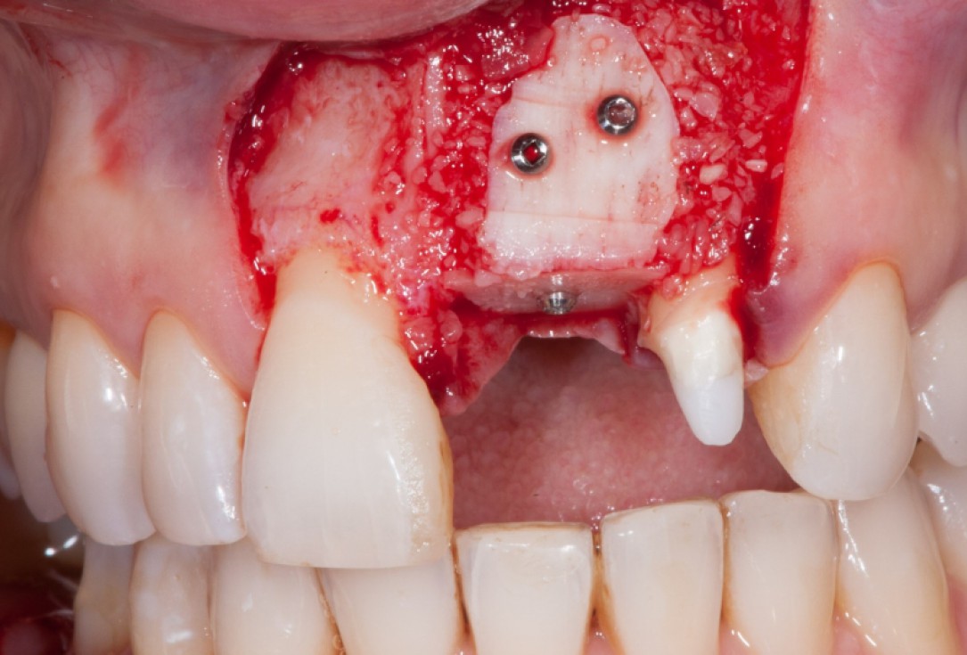 Augmentation with maxgraft® cortico - Dr. K. Chmielewski