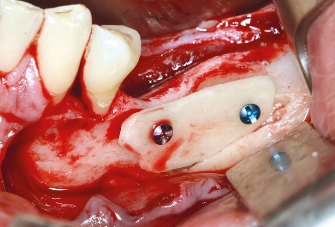 maxgraft® cortico at free-end situation in the mandible - J. Kielhorn