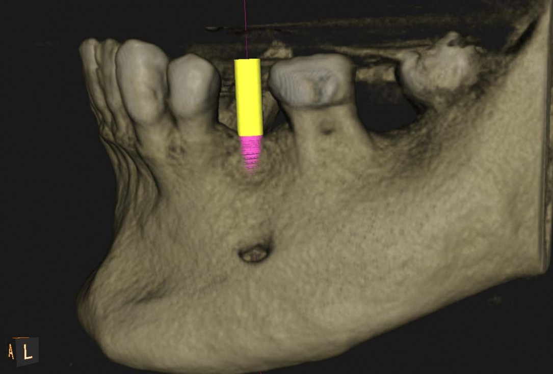 Reconstruction of a single tooth defect with the shell technique - Dr. Andoni Jones