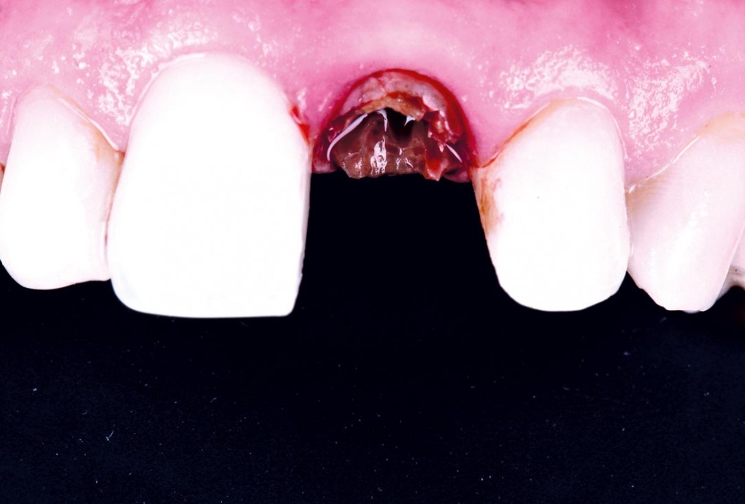 Excellent aesthetic result of buccal augmentation with mucoderm® and maxgraft® after immediate implant placement - 3-years follow-up - Dr. A. Puišys 