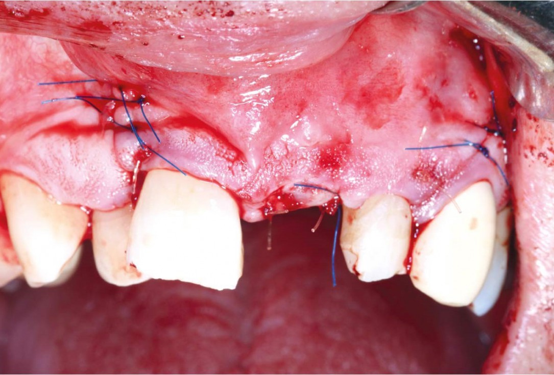 GBR using layering technique in aesthetic zone with maxgraft® and cerabone® -Dr. H. Maghaireh and Dr. V. Ivancheva
