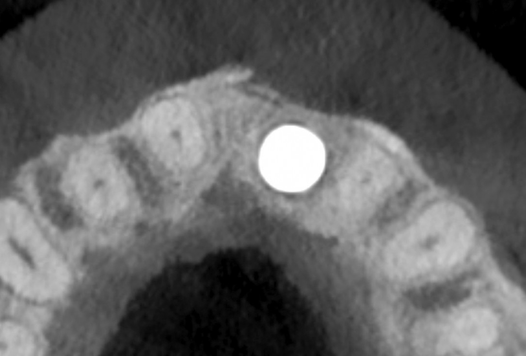 Block grafting in the aesthetic zone with maxgraft®, Jason® membrane and cerabone® - Dres. H. Maghaireh and V. Ivancheva