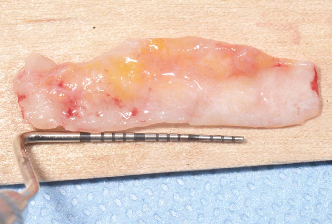 Full arch GBR using botiss cerabone®, maxgraft® and Jason® membrane with simultaneous implantation of 6 Straumann® implants - Dres. A. Signorio and G. Molina