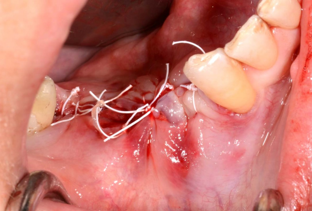 Vertical bone augmentation and broadening of attached gingiva using cerabone, permamem and mucoderm  -  Dr. R. Naimoli