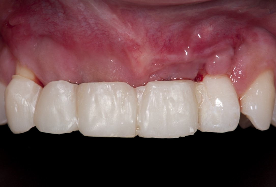 Block augmentation with maxgraft® block and mucoderm® - Dr. K. Chmielewski