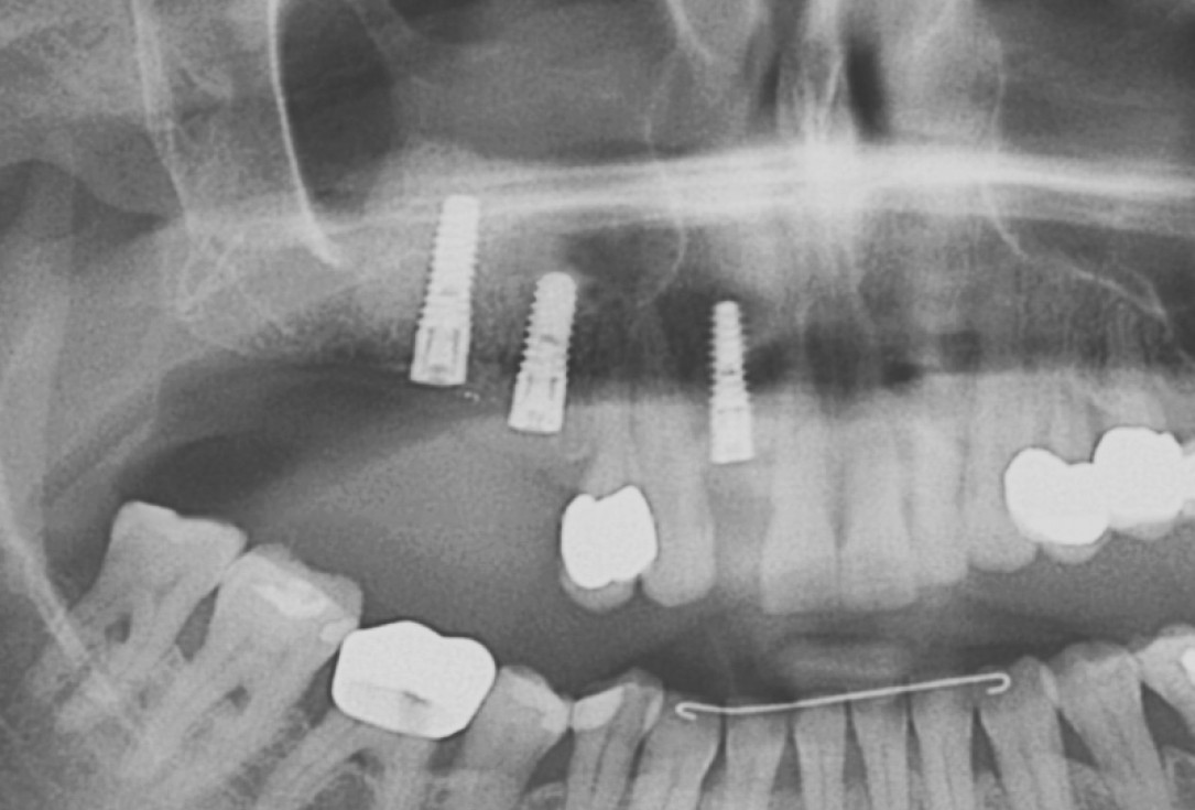 20/20 GBR with maxresorb® and Jason® membrane - Prof. Dr. Dr. D. Rothamel