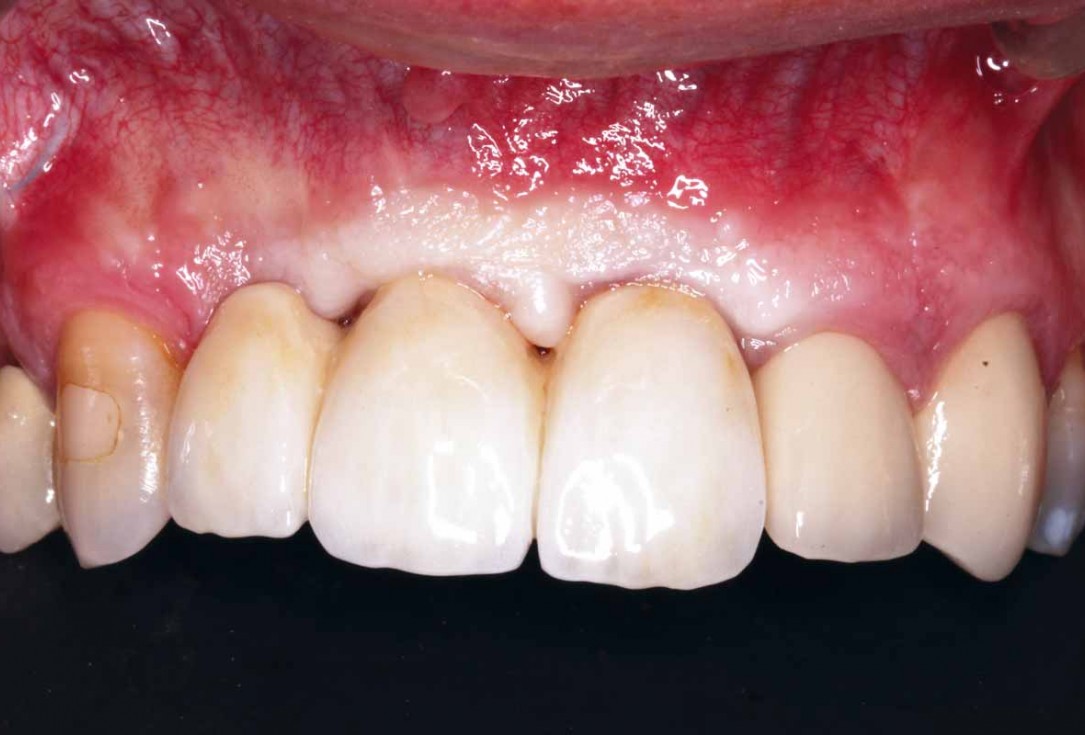 GBR and soft tissue augmentation with cerabone® and mucoderm® - H. Maghaireh & V. Ivancheva