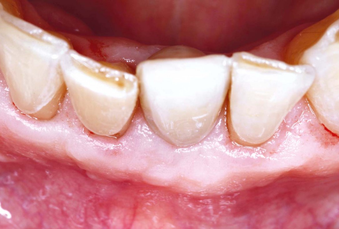 botiss cerabone and mucoderm for bone regeneration and implant supported rehabilitation of a periodontally involved incisor - clinical case