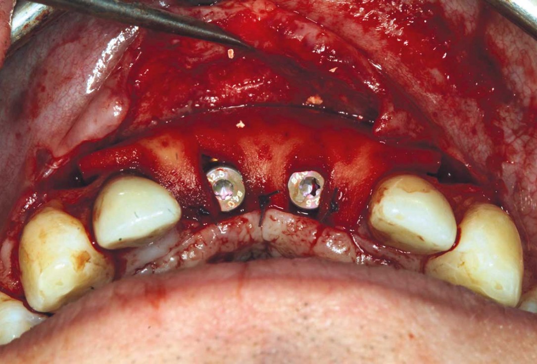 Ridge augmentation in the maxilla with maxgraft® bonebuilder in the aesthetic zone - Dr. M. Kristensen