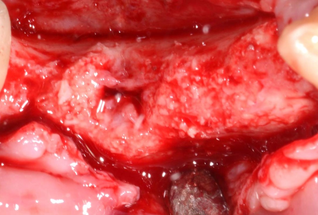 Vertical bone augmentation and broadening of attached gingiva using cerabone, permamem and mucoderm  -  Dr. R. Naimoli