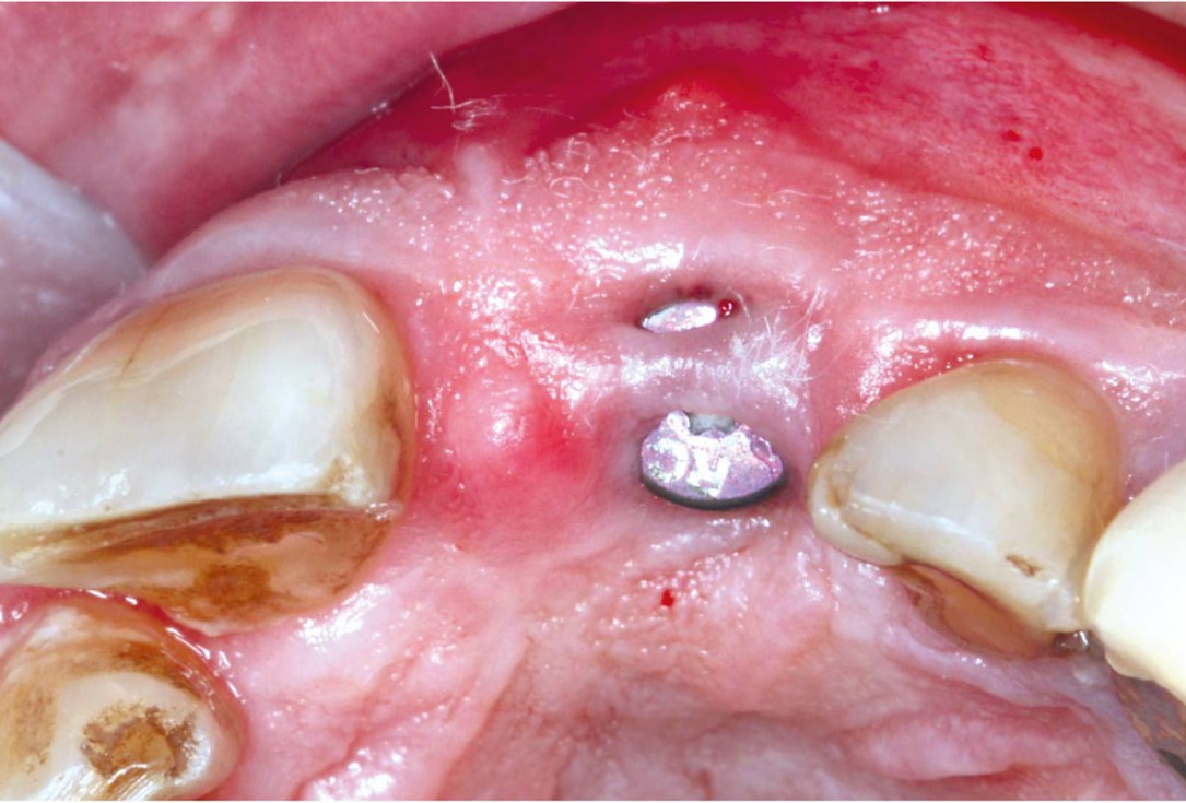 GBR using layering technique in aesthetic zone with maxgraft® and cerabone® -Dr. H. Maghaireh and Dr. V. Ivancheva