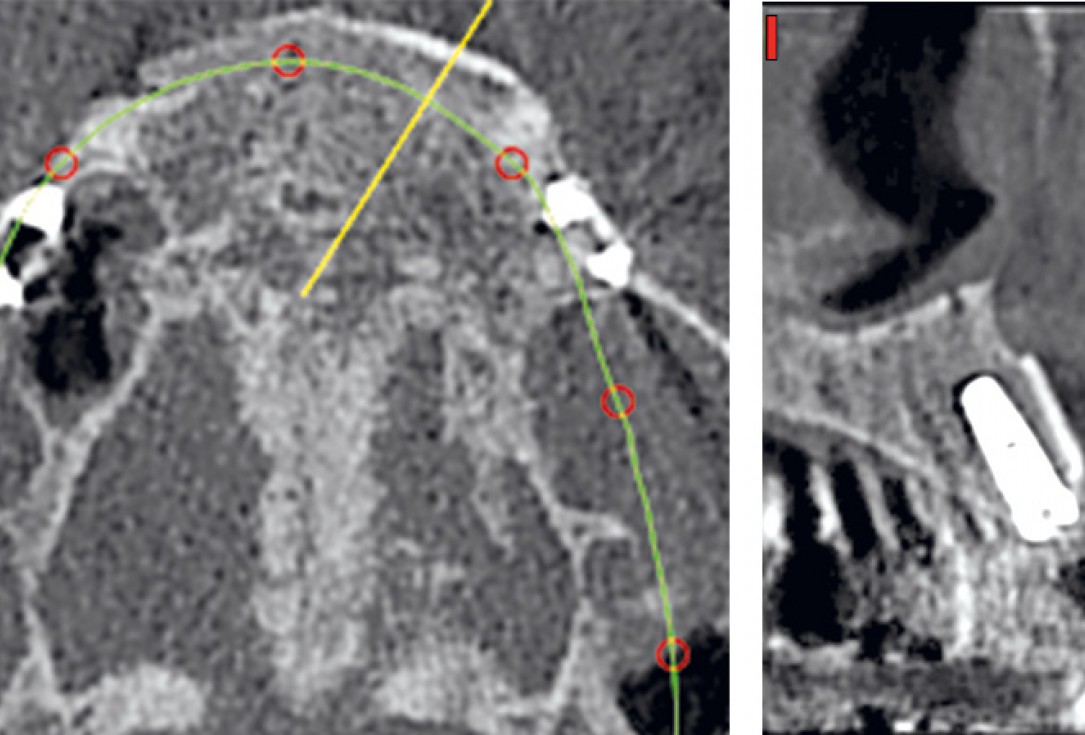 Three-dimensional augmentation with maxgraft® cortico - M.Sc. E. Kapogianni