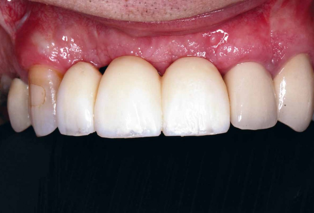 GBR and soft tissue augmentation with cerabone® and mucoderm® - H. Maghaireh & V. Ivancheva