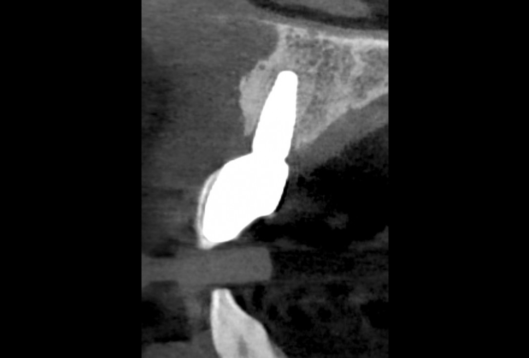 Block grafting in the aesthetic zone with maxgraft®, Jason® membrane and cerabone® - Dres. H. Maghaireh and V. Ivancheva