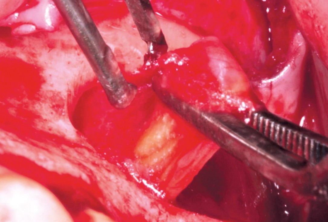 Maxillary sinus cyst removal using the Crocodile Technique and subsequent lateral sinus lift with cerabone®, maxgraft® and Jason® membrane - Dres. C. Scognamiglio and A. Perucchi 