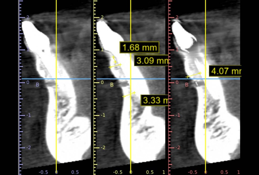 botiss cerabone and mucoderm for bone regeneration and implant supported rehabilitation of a periodontally involved incisor - clinical case