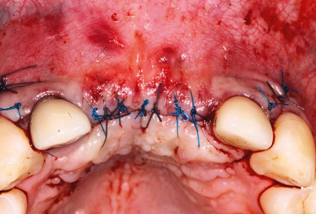 Ridge augmentation in the maxilla with maxgraft® bonebuilder in the aesthetic zone - Dr. M. Kristensen