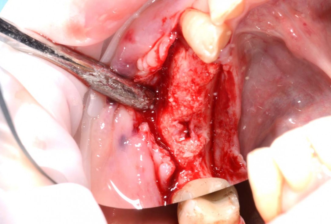 Vertical bone augmentation and broadening of attached gingiva using cerabone, permamem and mucoderm  -  Dr. R. Naimoli