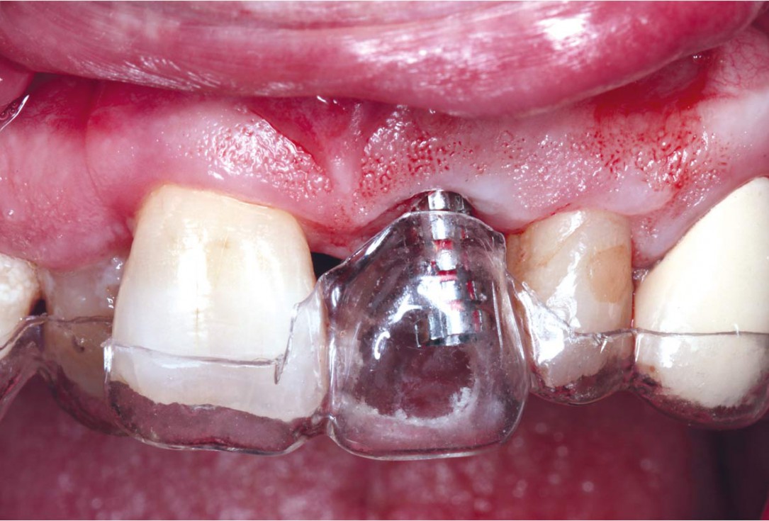 GBR using layering technique in aesthetic zone with maxgraft® and cerabone® -Dr. H. Maghaireh and Dr. V. Ivancheva