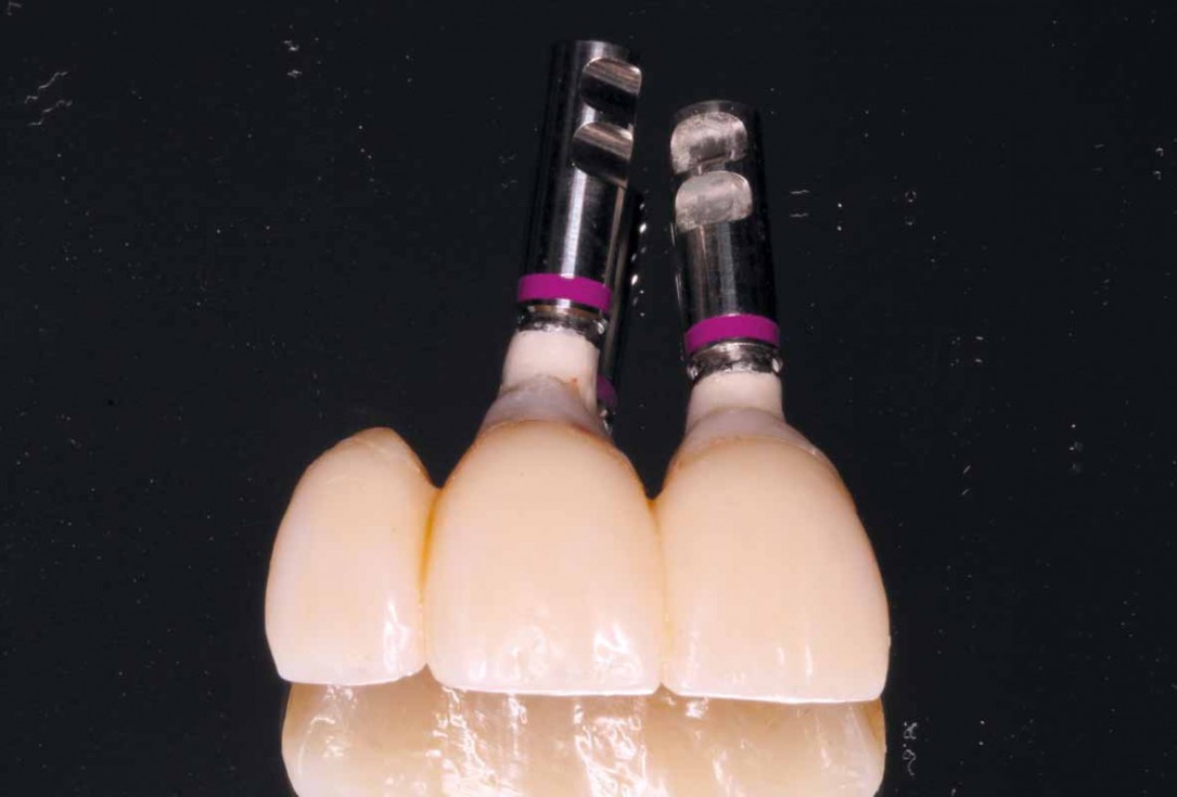 GBR and soft tissue augmentation with cerabone® and mucoderm® - H. Maghaireh & V. Ivancheva