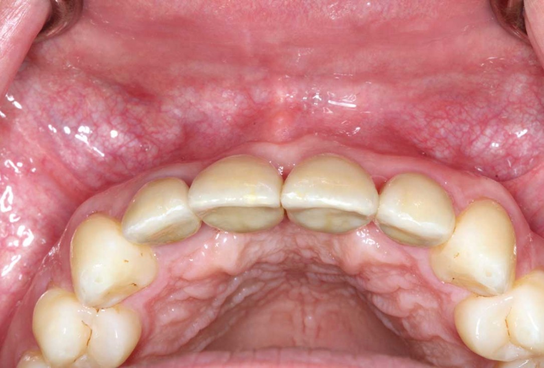 Ridge augmentation in the maxilla with maxgraft® bonebuilder in the aesthetic zone - Dr. M. Kristensen