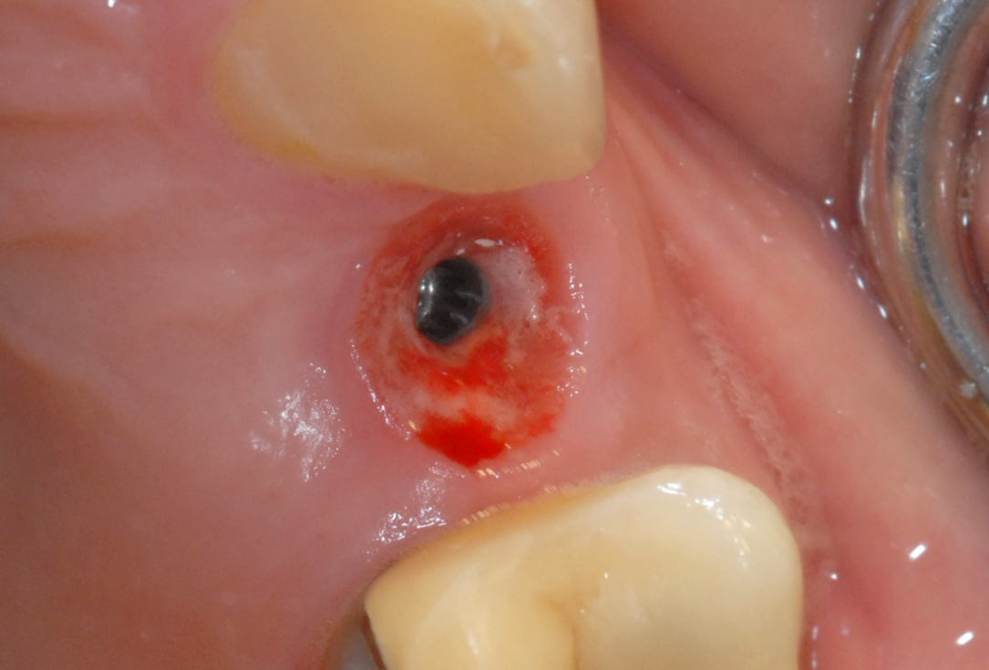 Ridge preservation with cerabone® and Jason® membrane - Dr. Derk Siebers