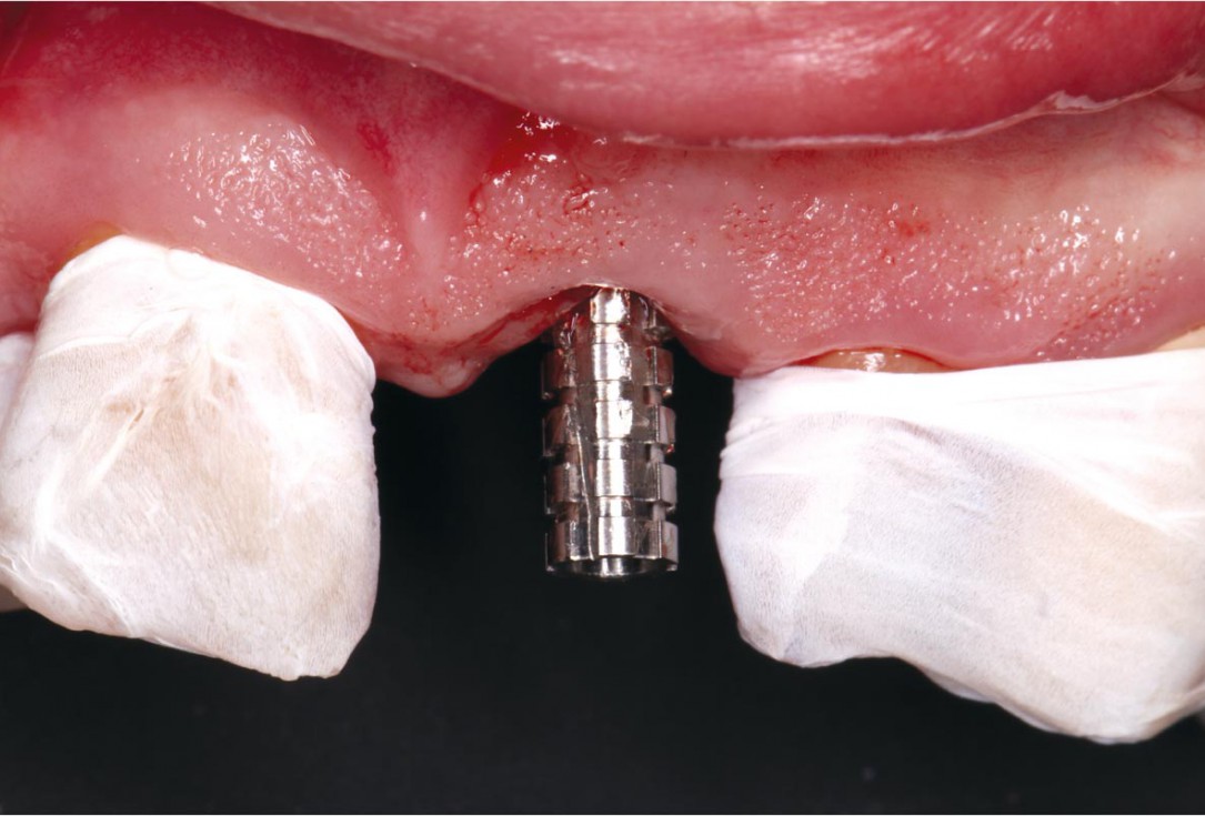 GBR using layering technique in aesthetic zone with maxgraft® and cerabone® -Dr. H. Maghaireh and Dr. V. Ivancheva