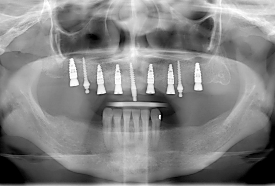 Full arch GBR using botiss cerabone®, maxgraft® and Jason® membrane with simultaneous implantation of 6 Straumann® implants - Dres. A. Signorio and G. Molina