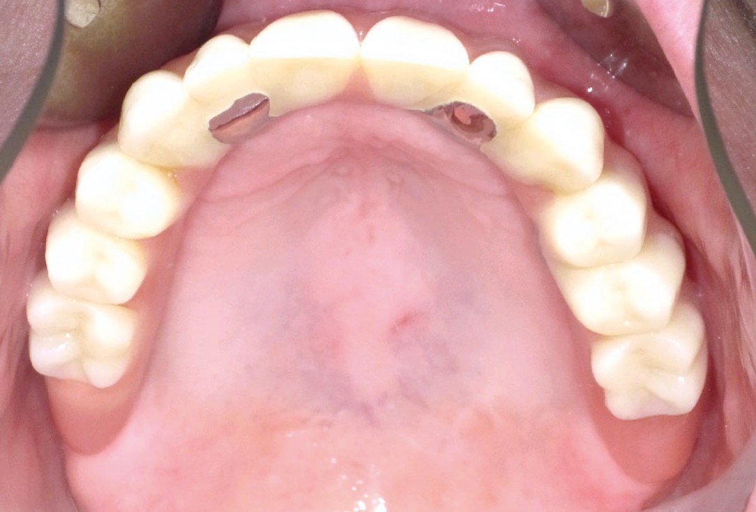 botiss maxgraft® bonebuilder for maxilla reconstruction - Clinical case