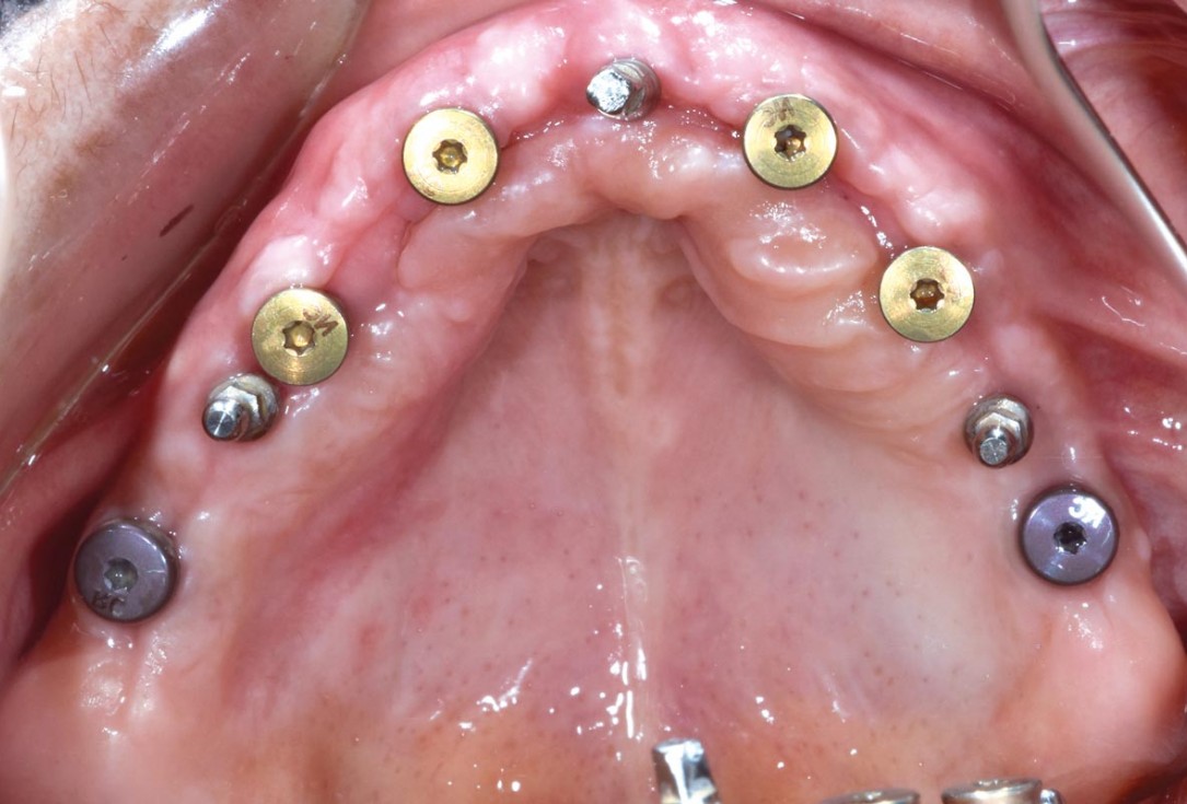 Full arch GBR using botiss cerabone®, maxgraft® and Jason® membrane with simultaneous implantation of 6 Straumann® implants - Dres. A. Signorio and G. Molina