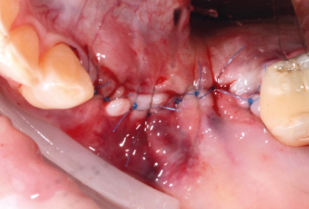 Vertical bone augmentation and broadening of attached gingiva using cerabone, permamem and mucoderm  -  Dr. R. Naimoli